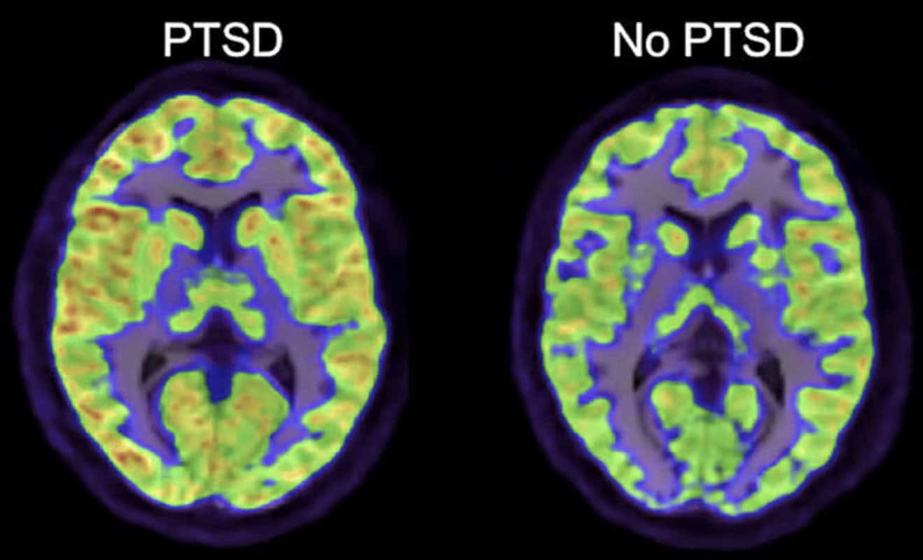 Two brain scan images side by side. The left is labeled "PTSD" and shows altered brain activity patterns compared to the right scan labeled "No PTSD". Color differences highlight areas of reduced or heightened brain activity.